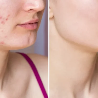 ژل ضدجوش و لایه بردار دیفرین