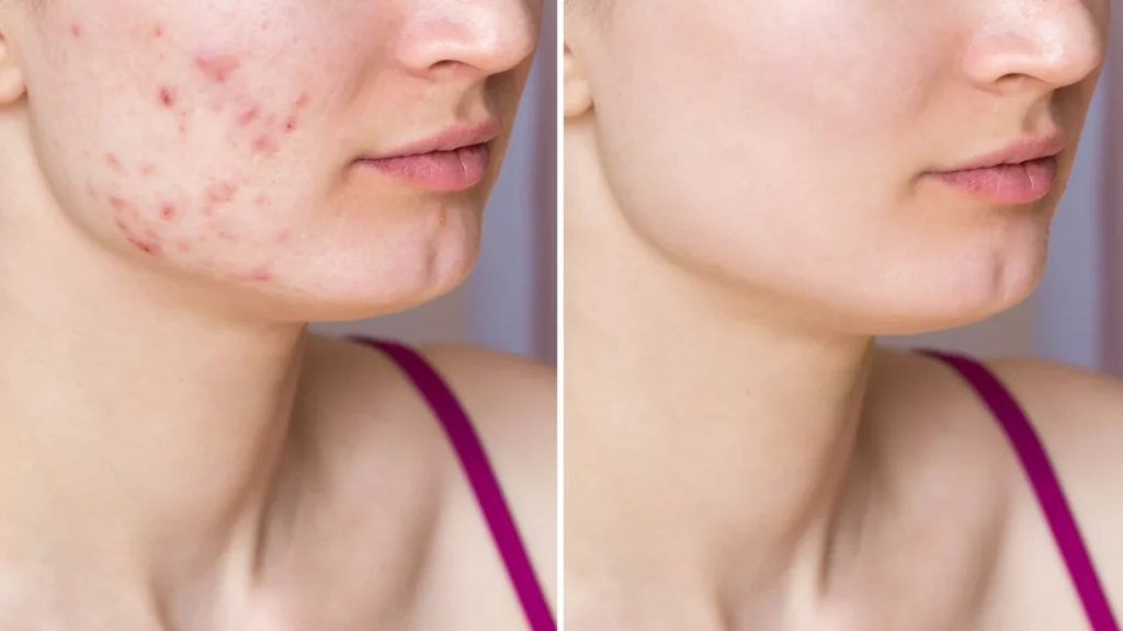 ژل ضدجوش و لایه بردار دیفرین
